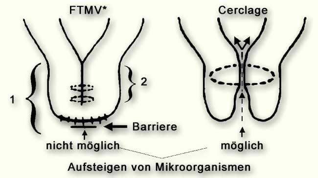 Abb. 1: Vergleich zwischen Muttermund-Verschluss und Cerclage