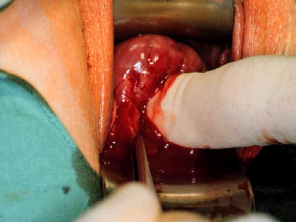 Abb. 10: Einführen des Fingers Richtung innerer Muttermund